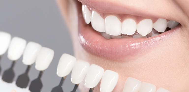 Porselen Veneer Nasıl Yapılır?