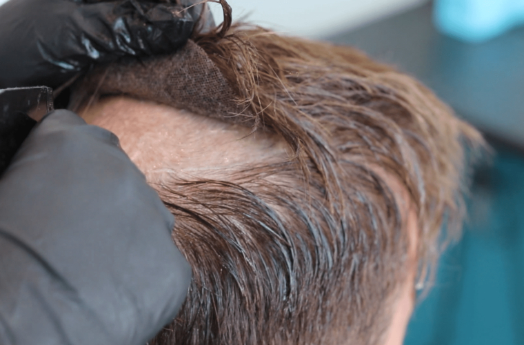 Protez Saç ile Kalıcı Çözüm ve Doğal Görünüm